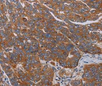 Immunohistochemical analysis of paraffin-embedded Human ovarian cancer tissue using #37799 at dilution 1/30.