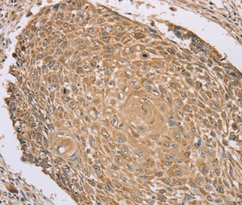 Immunohistochemical analysis of paraffin-embedded Human lung cancer tissue using #37874 at dilution 1/45.
