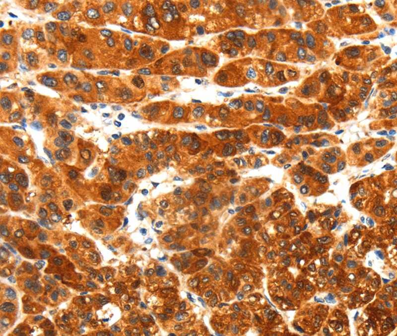 Immunohistochemical analysis of paraffin-embedded Human liver cancer tissue using #40206 at dilution 1/25.