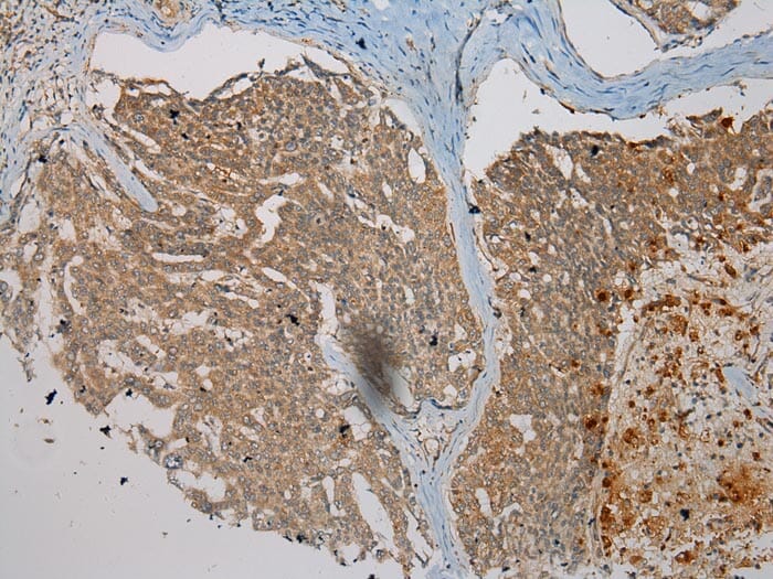 Immunohistochemical analysis of paraffin-embedded Human Liver cancer tissue using #40298 at dilution 1/200.