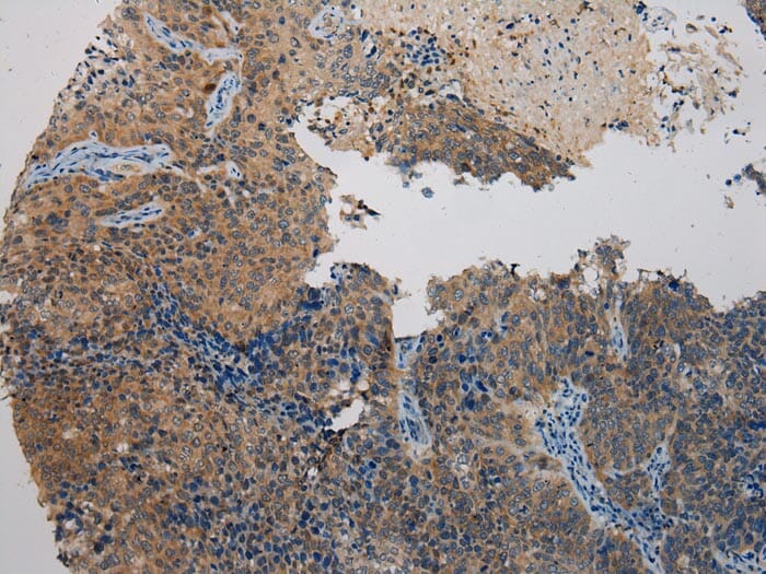 Immunohistochemical analysis of paraffin-embedded Human Cervical cancer tissue using #40298 at dilution 1/200.