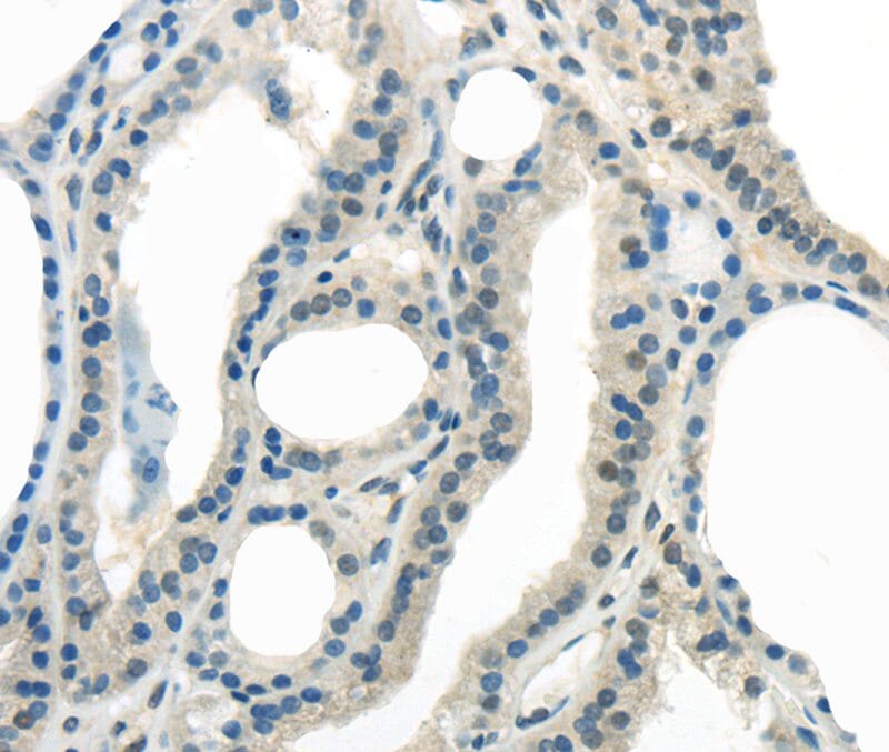 Immunohistochemical analysis of paraffin-embedded Human thyroid cancer tissue using #40405 at dilution 1/25.