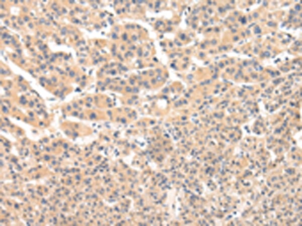 Immunohistochemical analysis of paraffin-embedded Human liver cancer tissue using #42843 at dilution 1/25.