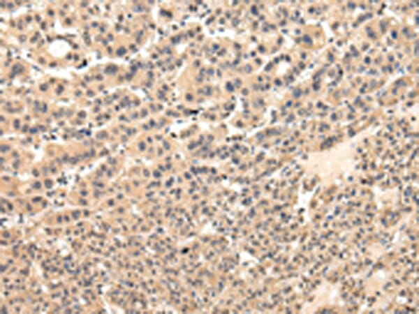 Immunohistochemical analysis of paraffin-embedded Human liver cancer tissue using #42845 at dilution 1/30.