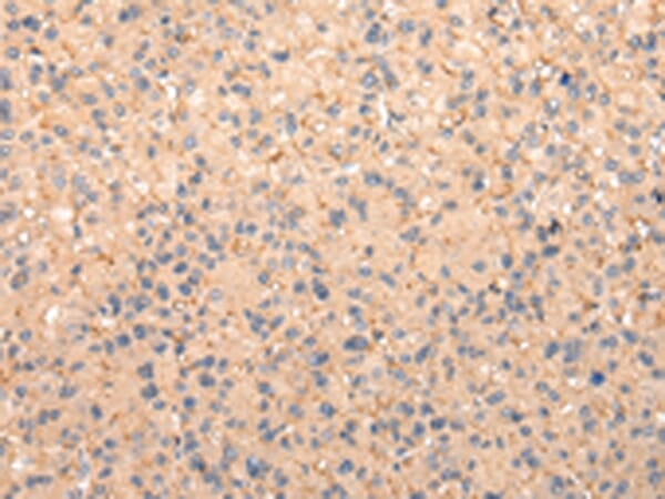 Immunohistochemical analysis of paraffin-embedded Human liver cancer tissue using #42869 at dilution 1/25,