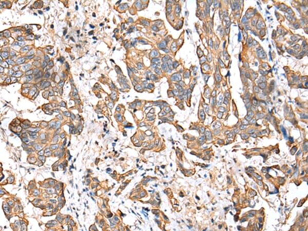 Immunohistochemical analysis of paraffin-embedded Human breast cancer tissue using #42892 at dilution 1/25,