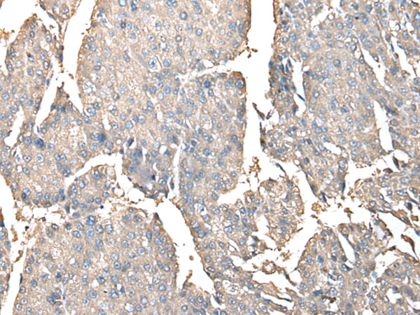 Immunohistochemical analysis of paraffin-embedded Human liver cancer tissue using #42924 at dilution 1/30.