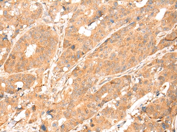 Immunohistochemical analysis of paraffin-embedded Human colorectal cancer tissue using #43112 at dilution 1/25.