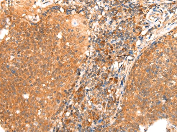 Immunohistochemical analysis of paraffin-embedded Human cervical cancer tissue using #43112 at dilution 1/25.