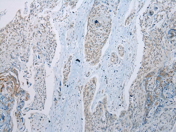 Immunohistochemical analysis of paraffin-embedded Human Oesophagus cancer tissue using #43114 at dilution 1/100.