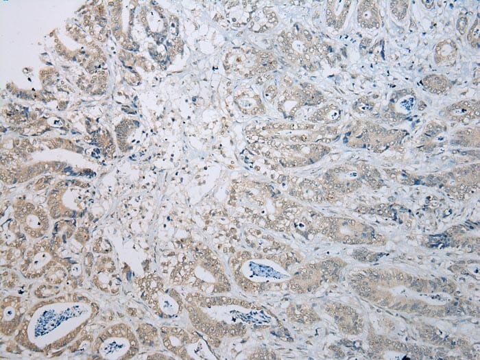 Immunohistochemical analysis of paraffin-embedded Human Gastric cancer tissue using #43114 at dilution 1/100.
