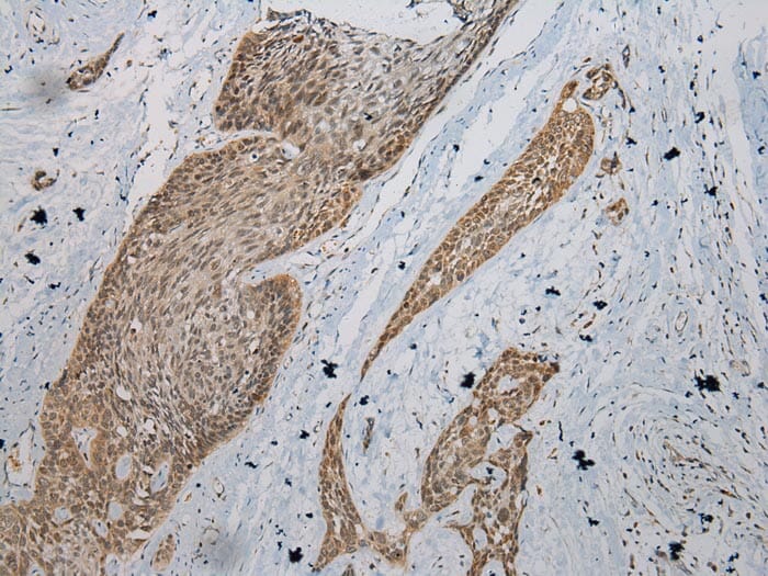 Immunohistochemical analysis of paraffin-embedded Human Oesophagus cancer tissue using #43176 at dilution 1/200.