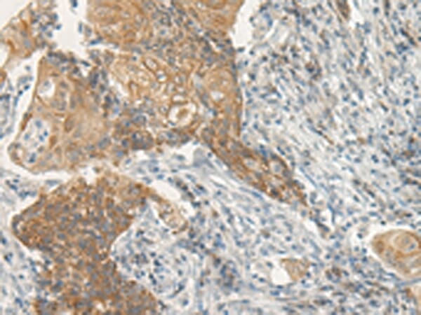 Immunohistochemical analysis of paraffin-embedded Human cervical cancer tissue using #43181 at dilution 1/35,