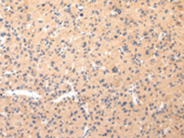 Immunohistochemical analysis of paraffin-embedded Human liver cancer tissue using #43219 at dilution 1/20.