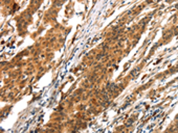 Immunohistochemical analysis of paraffin-embedded Human gastric cancer tissue using #43411 at dilution 1/25,