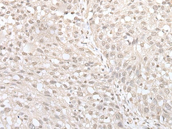 The image on the left is immunohistochemistry of paraffin-embedded Human lung cancer tissue using MIF4GD Antibody at dilution 1/30, on the right is treated with fusion protein. (Original magnification: x200)