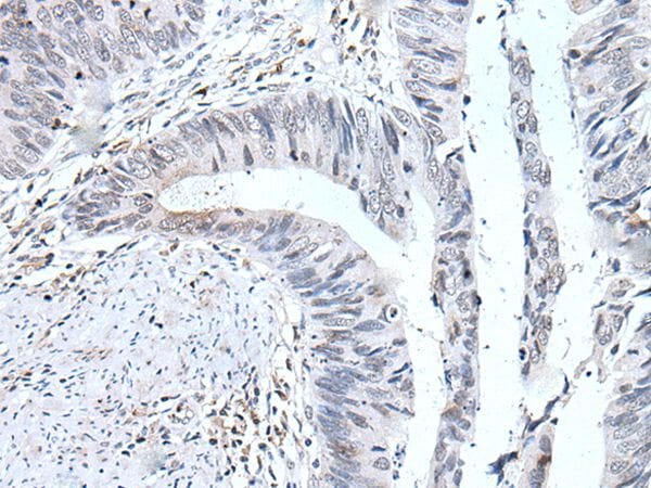 The image on the left is immunohistochemistry of paraffin-embedded Human colorectal cancer tissue using UBE2T Antibody at dilution 1/30, on the right is treated with fusion protein. (Original magnification: x200)