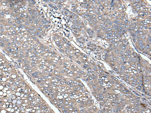 The image on the left is immunohistochemistry of paraffin-embedded Human liver cancer tissue using UNC13B Antibody at dilution 1/100, on the right is treated with fusion protein. (Original magnification: x200)
