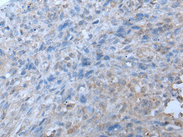 The image on the left is immunohistochemistry of paraffin-embedded Human lung cancer tissue using TRIP11 Antibody at dilution 1/20, on the right is treated with synthetic peptide. (Original magnification: x200)