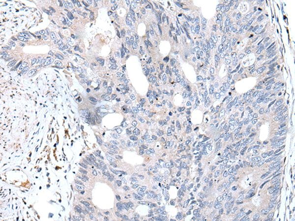 The image on the left is immunohistochemistry of paraffin-embedded Human colorectal cancer tissue using FABP12 Antibody at dilution 1/30, on the right is treated with synthetic peptide. (Original magnification: x200)