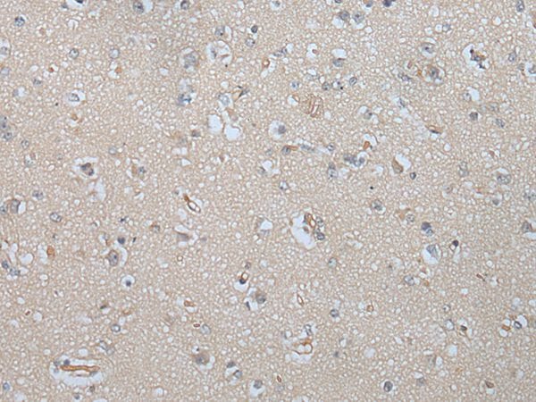 The image on the left is immunohistochemistry of paraffin-embedded Human brain tissue using MAGEB5 Antibody at dilution 1/25, on the right is treated with synthetic peptide. (Original magnification: x200)