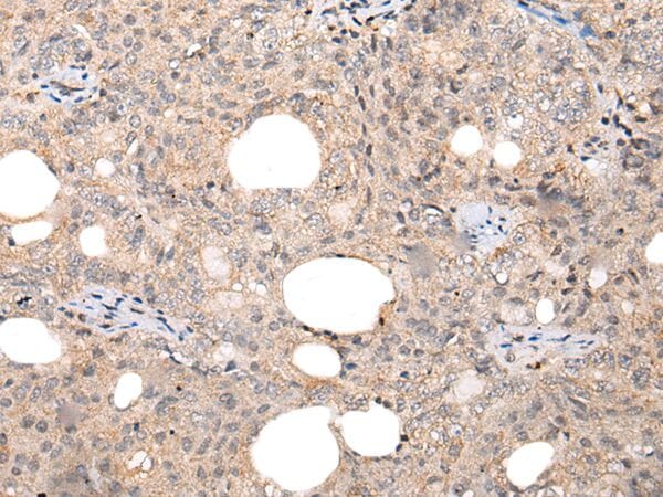 The image on the left is immunohistochemistry of paraffin-embedded Human ovarian cancer tissue using CHAMP1 Antibody at dilution 1/35, on the right is treated with synthetic peptide. (Original magnification: x200)