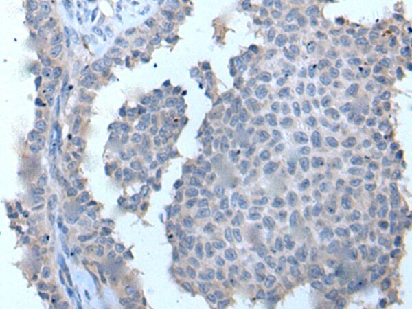 The image on the left is immunohistochemistry of paraffin-embedded Human ovarian cancer tissue using ZDHHC5 Antibody at dilution 1/20, on the right is treated with synthetic peptide. (Original magnification: x200)