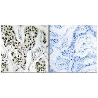 Immunohistochemistry analysis of paraffin-embedded human breast carcinoma tissue using ZC3H4 antibody #35155.