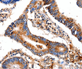 Immunohistochemical analysis of paraffin-embedded Human gastric cancer tissue using #35584 at dilution 1/12.