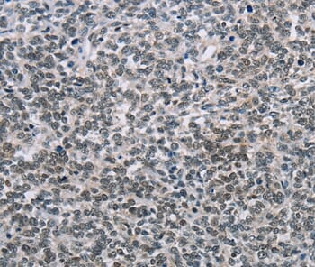 Immunohistochemical analysis of paraffin-embedded Human ovarian cancer tissue using #35590 at dilution 1/60.
