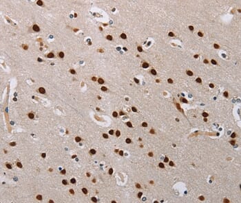 Immunohistochemical analysis of paraffin-embedded Human brain cancer tissue using #35590 at dilution 1/60.
