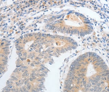 Immunohistochemical analysis of paraffin-embedded Human colon cancer tissue using #35633 at dilution 1/25.