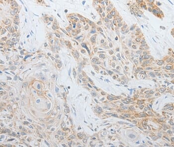 Immunohistochemical analysis of paraffin-embedded Human oesophagus cancer tissue using #35633 at dilution 1/25.