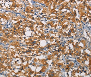 Immunohistochemical analysis of paraffin-embedded Human thyroid cancer tissue using #35697 at dilution 1/60.