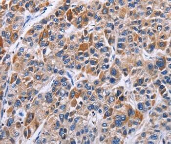 Immunohistochemical analysis of paraffin-embedded Human liver cancer tissue using #35725 at dilution 1/40.