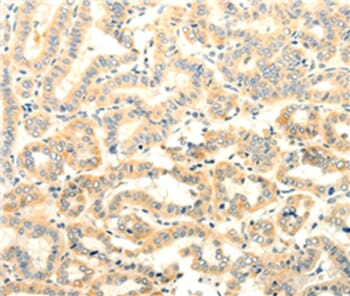 Immunohistochemical analysis of paraffin-embedded Human lung cancer tissue using #35740 at dilution 1/25.