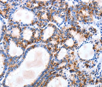 Immunohistochemical analysis of paraffin-embedded Human thyroid cancer tissue using #35776 at dilution 1/10.