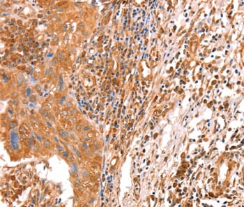 Immunohistochemical analysis of paraffin-embedded Human cervical cancer tissue using #36015 at dilution 1/10.