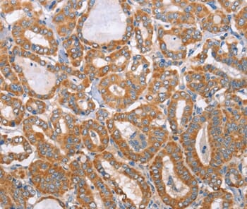 Immunohistochemical analysis of paraffin-embedded Human thyroid cancer tissue using #36184 at dilution 1/40.