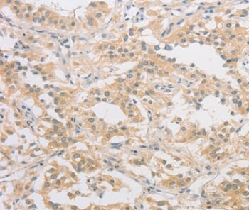 Immunohistochemical analysis of paraffin-embedded Human thyroid cancer tissue using #36191 at dilution 1/40.