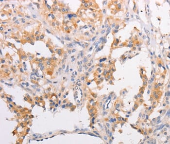 Immunohistochemical analysis of paraffin-embedded Human thyroid cancer tissue using #36204 at dilution 1/30.
