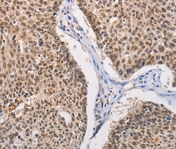 Immunohistochemical analysis of paraffin-embedded Human lung cancer tissue using #36204 at dilution 1/30.