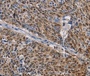 Immunohistochemical analysis of paraffin-embedded Human liver cancer tissue using #36220 at dilution 1/50.