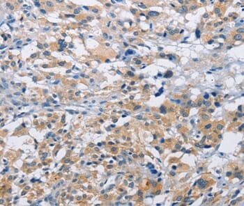 Immunohistochemical analysis of paraffin-embedded Human thyroid cancer tissue using #36229 at dilution 1/15.