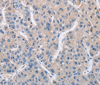 Immunohistochemical analysis of paraffin-embedded Human liver cancer tissue using #36229 at dilution 1/15.