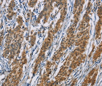 Immunohistochemical analysis of paraffin-embedded Human gastric cancer tissue using #36233 at dilution 1/60.