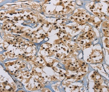 Immunohistochemical analysis of paraffin-embedded Human thyroid cancer tissue using #36233 at dilution 1/60.