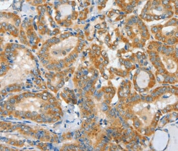 Immunohistochemical analysis of paraffin-embedded Human thyroid cancer tissue using #36243 at dilution 1/30.