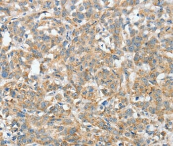 Immunohistochemical analysis of paraffin-embedded Human oesophagus cancer tissue using #36243 at dilution 1/30.