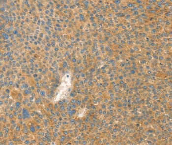 Immunohistochemical analysis of paraffin-embedded Human liver cancer tissue using #36248 at dilution 1/40.